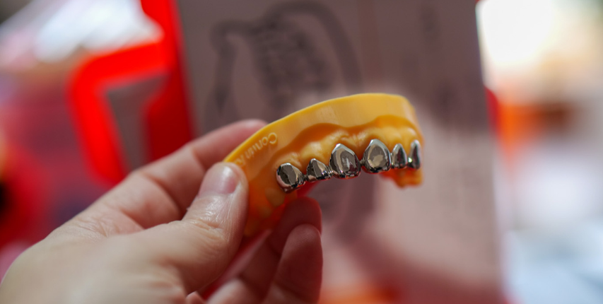 Grillz sur mesure Rennes - bretagne