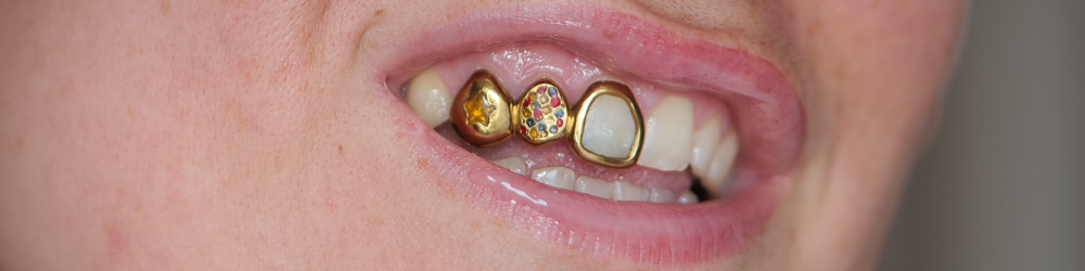 Grillz sur mesure à Rennes et en Bretagne