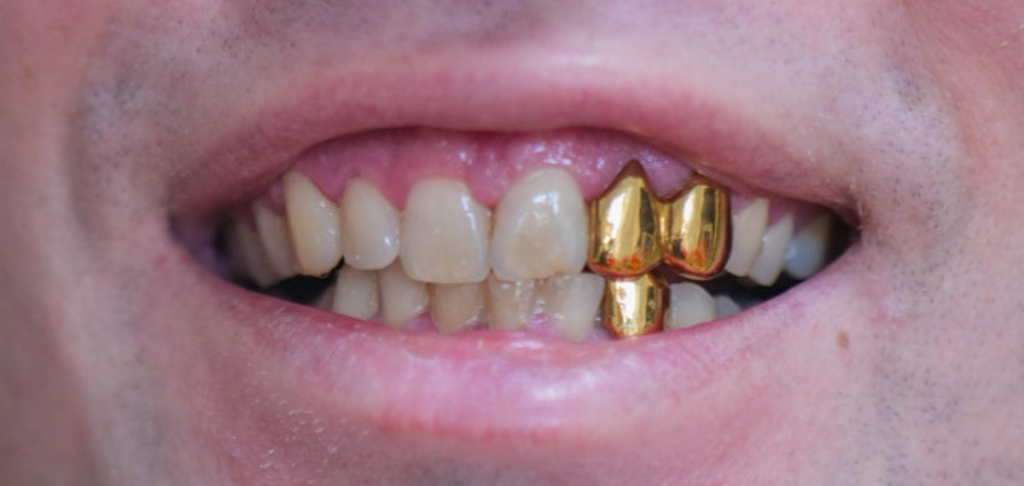 Grillz sur mesure à Rennes - bretagne