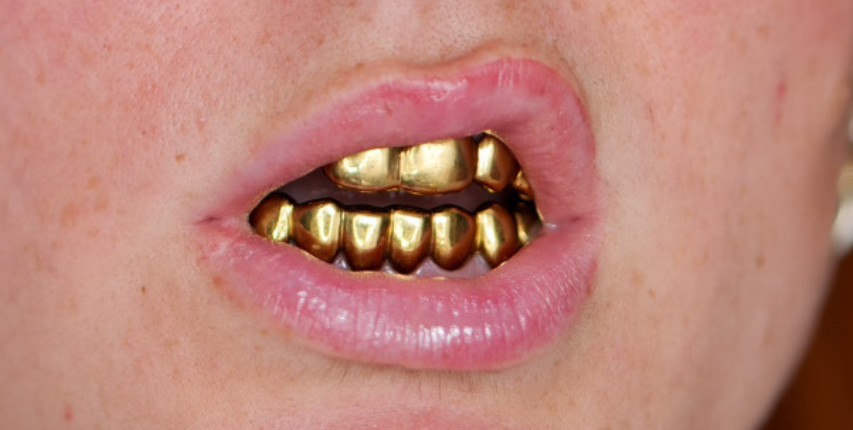 Dent en or - grillz sur mesure à Rennes - Bretagne