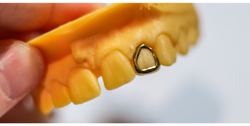 Grillz sur mesure à Rennes - Bretagne